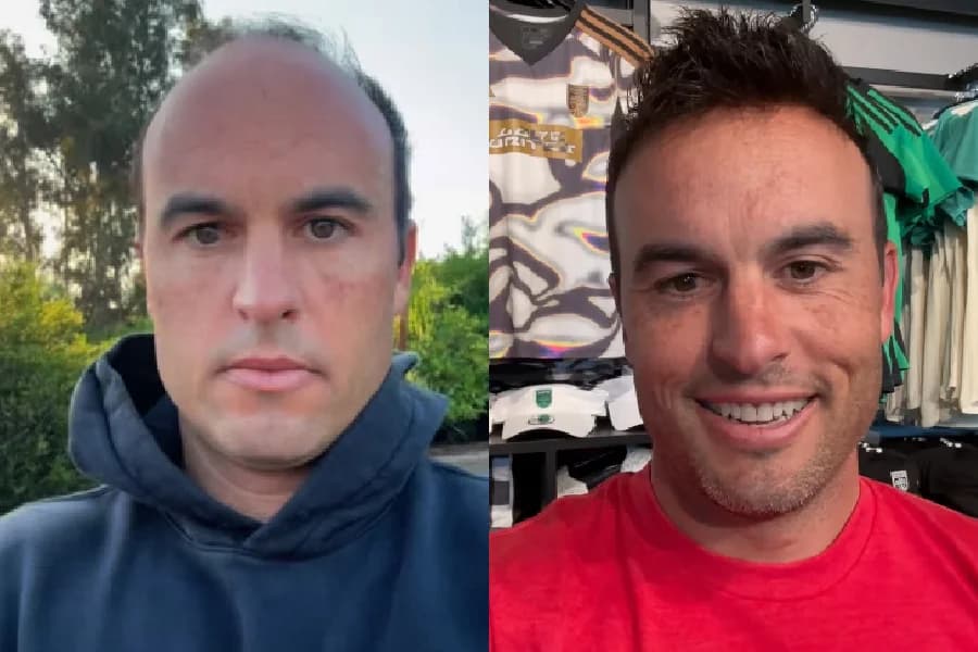 Ídolo americano Donovan retoma autoestima ao vencer a calvície