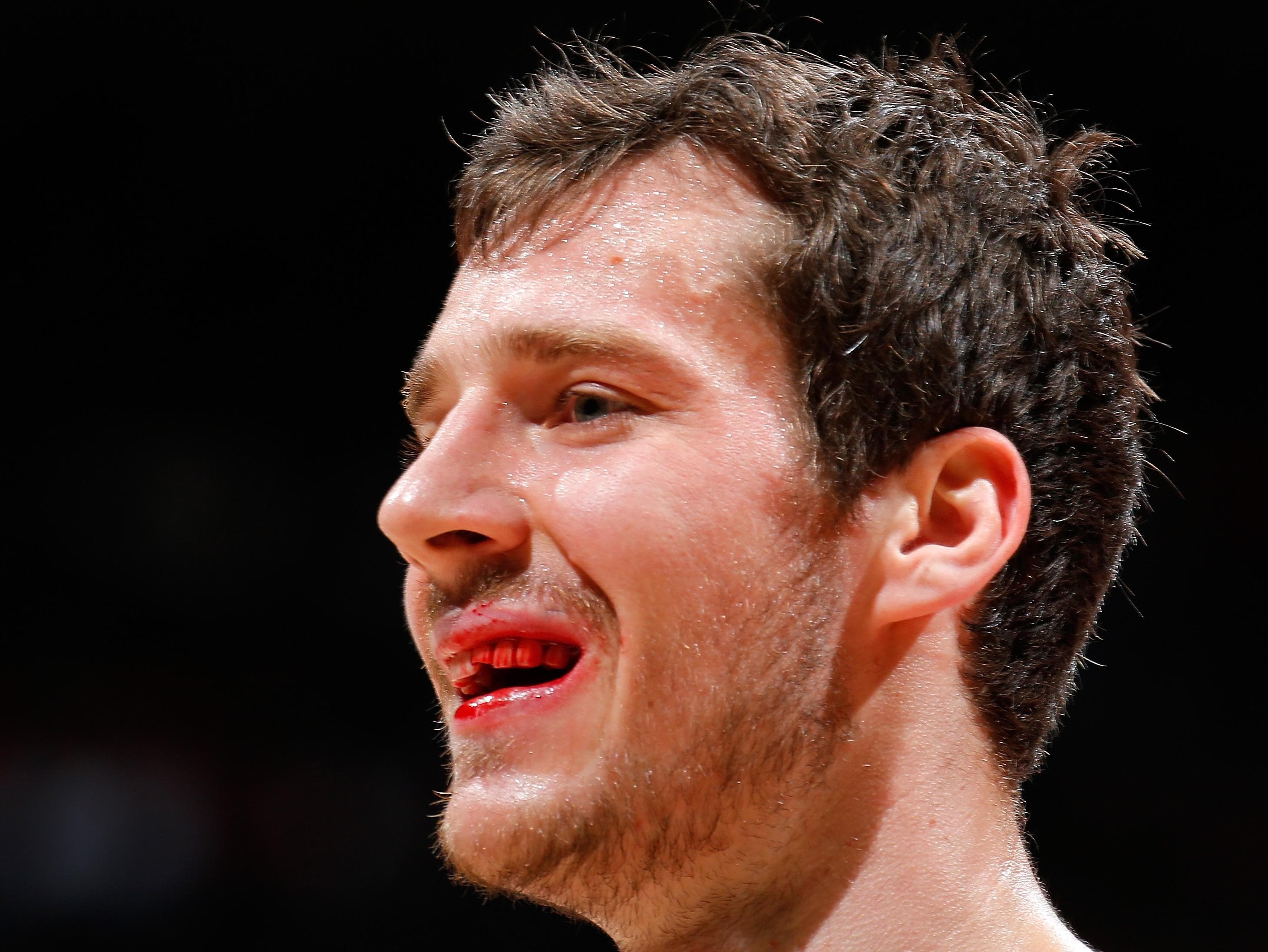 Goran Dragic, do Miami Heat, perdeu parte do dente na partida contra o Atlanta Hawks