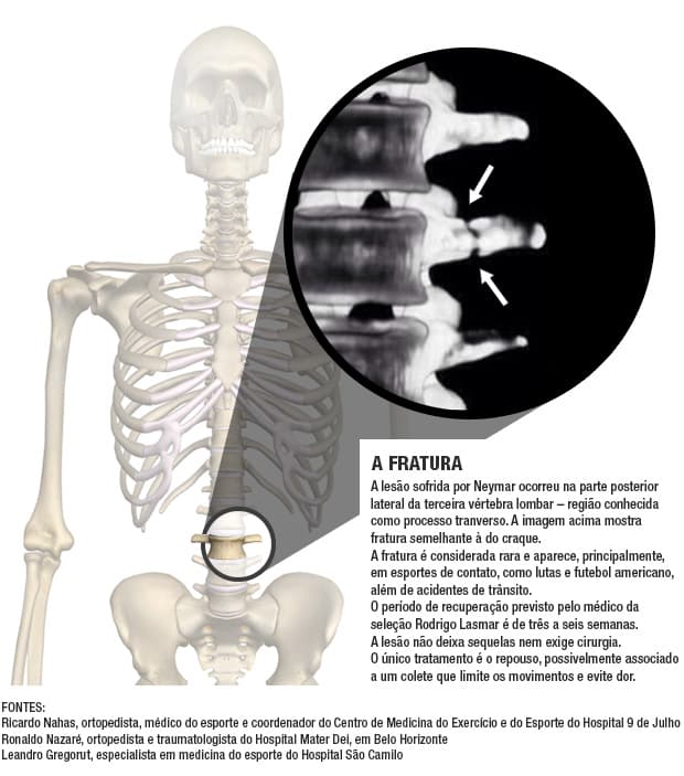 A fratura que tirou Neymar da Copa
