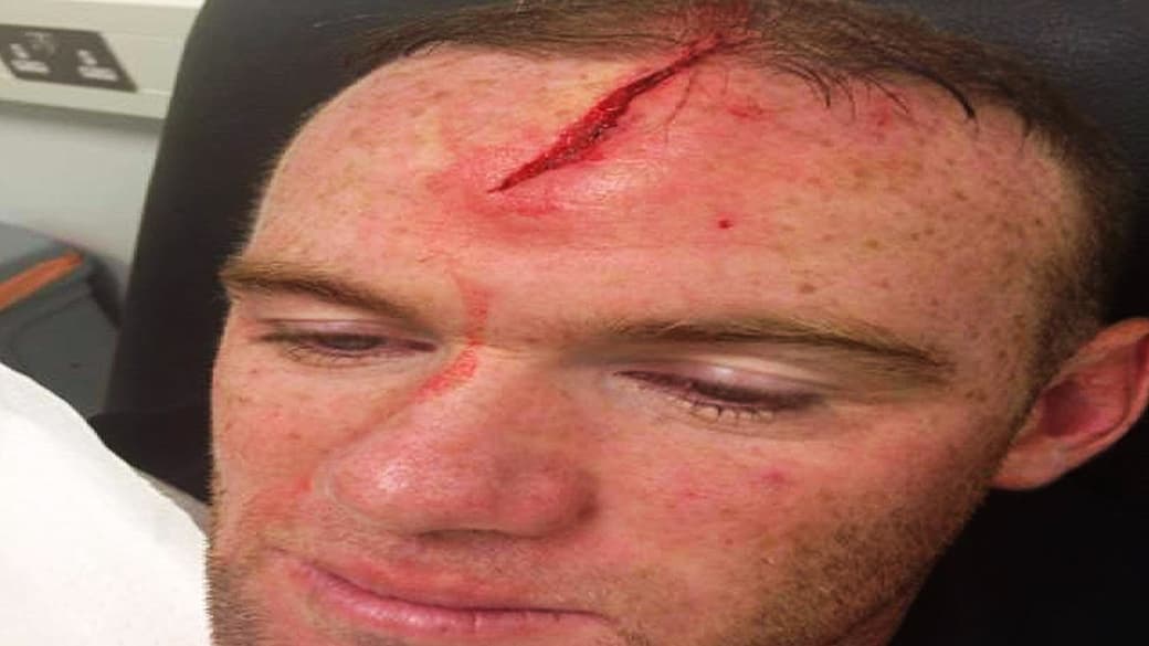 Rooney precisou de dez pontos na testa após o choque com o zagueiro Phil Jones