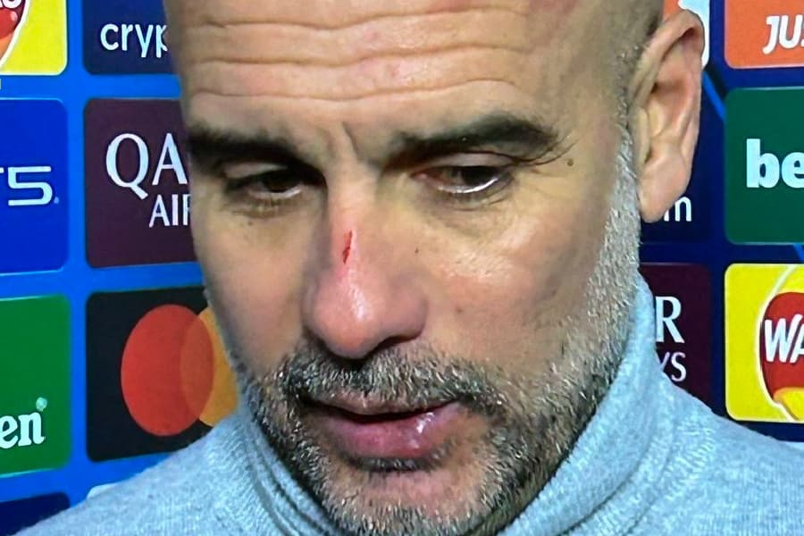 Guardiola explica arranhões após novo tropeço do City