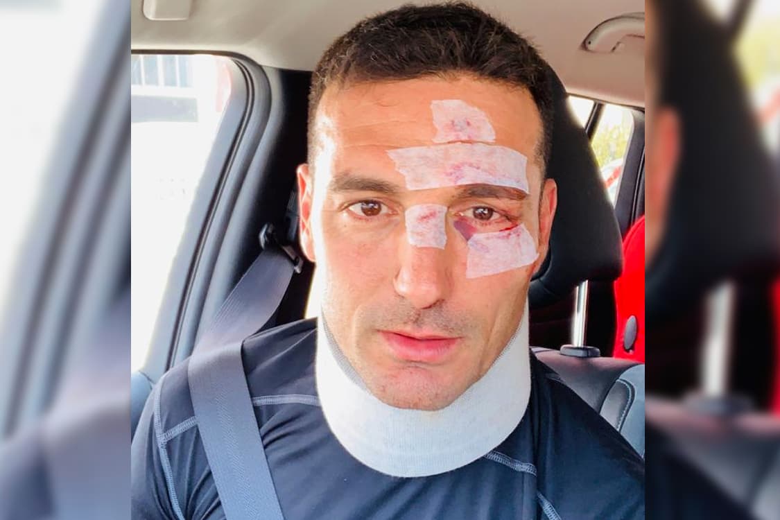 O técnico de futebol argentino Lionel Scaloni publica foto em seu Twitter após atropelamento – 09/04/2019