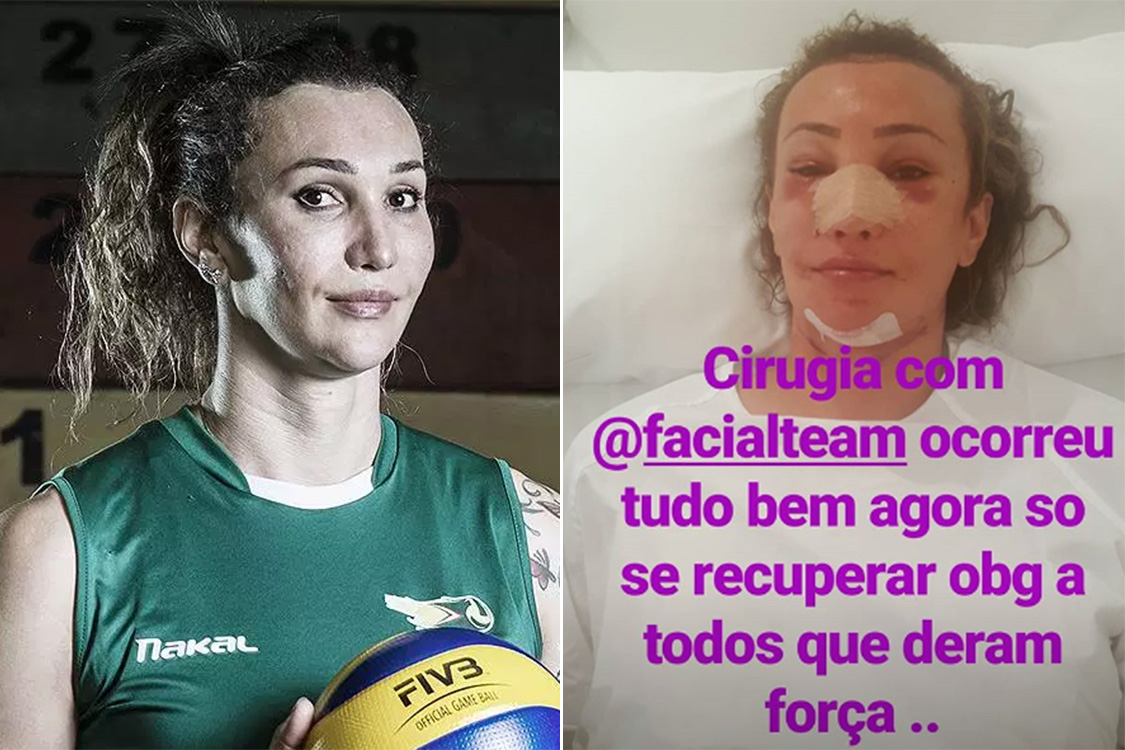 Vôlei: Tifanny Abreu passa por cirurgia de feminização facial